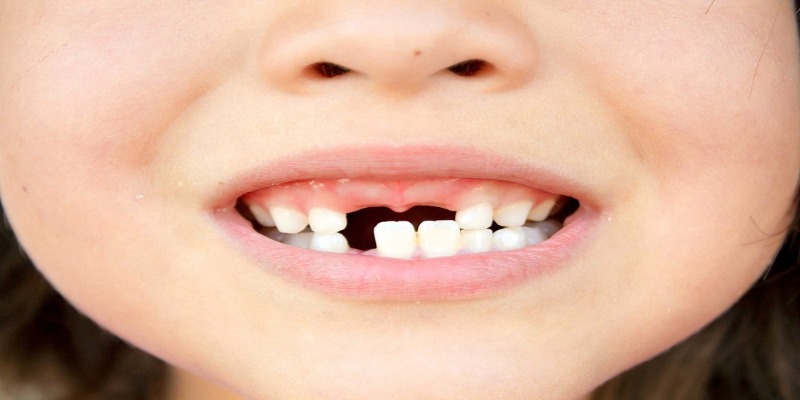 Rụng hàm dưới liên quan đến vấn đề đang bị che giấu
